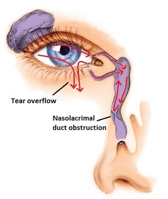Nasolacrimal Cystitis Nasolacrimal Cystitis